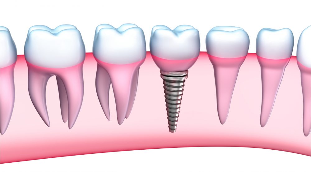 Care sunt componentele unui tratament de refacere a danturii cu implanturi dentare?