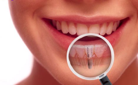 Care sunt componentele unui tratament de refacere a danturii cu implanturi dentare?