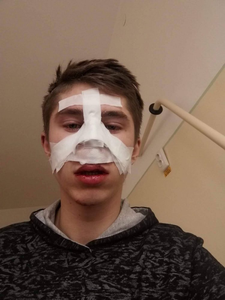 Târgu Neamț: Elev desfigurat la școală
