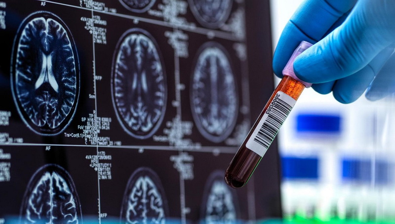 ARGUMENT PENTRU RUBRICĂ „Neurologia contemporană – frontiere și aplicații clinice” 4 alzheimer teste resize